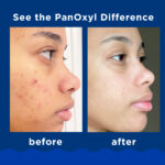 Panoxyl - Acne Foaming Wash Benzoyl Peroxide 10% Maximum Strength - Image 3