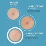 Iroha - NATURE SOS PIMPLE PATCHES - Image 2